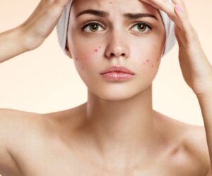 Trądzik kosmetyczny