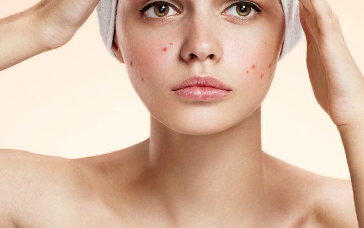 Trądzik kosmetyczny